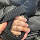 디엠씨(DMC)최한규피부과의원 | 아이 손이 문에 끼었을때 대처법, 손톱 빠지는 과정 및 회복 과정