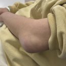 파라몰 | 팔꿈치 주두돌기 골절 4개월차 핀 제거 (입/퇴원) 골절수술+핀 제거 수술비용 비교