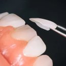 하나로치과기공소 | 원내기공소가 있을 때 라미네이트 치료 장점