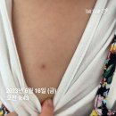 아이피지 | 피지낭종 표피낭종 아이 피부과 제거 타임라인