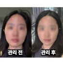 스튜디오시소 | (예신 후기) 쳐진 얼굴 리프팅 기가막히게 올려주는 평촌역 1인 피부관리실 시소에스테틱 내돈내산 후기