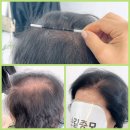 (주)한올 | 여자 정수리 가발 추천 한올 증모술 후기
