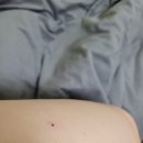 (주)동광레이저 | 잘 빼는 곳 신세계 가정의학과 (a.k.a. 대구 점공장) 레이저 점 제거 및 편평 사마귀 제거한 후기 및...