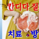 사암침, 사암침법 - 칸디다 질염 치료 방법 - 비과학적 양의학 134 이미지