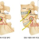 서울 아산병원/풍선확장술’ 이용한 척추 협착 새 치료법 개발 이미지