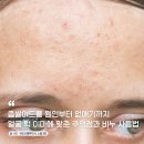 몽뜨뷰티 | 얼굴 턱 볼 이마에 난 좁쌀여드름 없애기 압출 화장품 비누 사용법