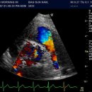 bicuspid aortic valve with Severe AS 이미지