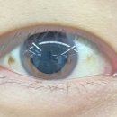 분도안과의원 | 안과의원 / 압구정 에스앤비안과 / 아이리움안과 : 스마일 수술 상담 및 수술 후기 → 시력 안...