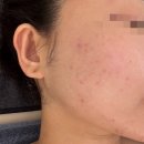 아쿠아 스플래쉬 봉선점 | [광주/남구] 봉선동 여드름 관리(압출/진정) 연아 스킨 랩