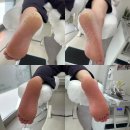 예스마트 후평점 | 춘천 발 뒤꿈치 갈라짐, 레푸스 후평점에서 해결한 찐 후기 (여름 준비 끝)