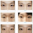 미고성형외과의원 | 미고성형외과의 완벽한 쌍꺼풀 재수술