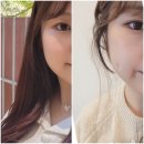 보조개 | 내돈내산 n년 지난 보조개 시술 후기 통증 부작용