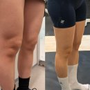 (주)팻라인 | 안빠지는 무릎살 청담 다이어트 전문피부과 이오팻주사 1회 놀라운 변화