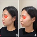 잠실새내역 | 잠실새내역 온다리프팅 이중턱 3만줄 후기