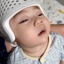 에이스파이브 | 아기 두상교정 8개월 완료 후기 (에이스밴드)