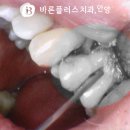 평촌역 치과 치주 재생 치료 통해 뼈 녹음 골소실 치조골 회복하여 잇몸 건강 되찾는 방법