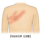 대상포진 (Herpes Zoster) 이미지