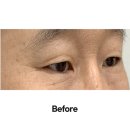 예스의원 | 강남 상안검수술 잘하는곳 세이예스의원, 가격과 후기 한 번에 보기