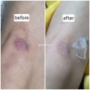 참좋은의료기기 | 흉터 관리 의료기기 추천 더마에스씨 수술흉터밴드 사용 후기 효과