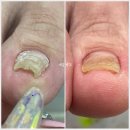 풀리메디시흥월곶점네일박스 | 시흥 월곶 내성발톱 무좀발톱 발톱무좀 발각질 풋케어 전문샵 네일박스