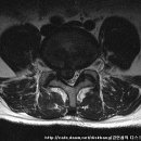 허리디스크 치료사례-7요추 4-5번간 추간판 탈출증 김*완님 남자/38세(치료전-후 MRI사진비교) 이미지