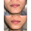 유동길 | 광주 북구 라스킨에스테틱 성인 여드름 관리 4달 후기 내돈내산