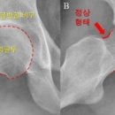 "고관절 충돌증후군에 관절경 수술 효과" 이미지