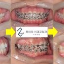 로미오치과교정과치과의원 네이버블로그