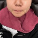 얼굴살, 볼살과 턱살 빼는 법... 레스팻 시술 후기