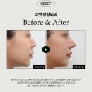 리셋성형외과의원 네이버블로그