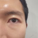 노원역 쌍꺼풀 수술, 쌍수, 쌍꺼풀 재수술 feat. 리안성형외과