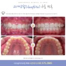바른해치과 네이버블로그