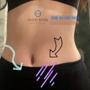 복부지방흡입 부작용 (바이오본드 뭉침 유착) 오래된 지흡 부작용도 좋아져요ㅣ후기 확인
