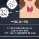 아급성 갑상선염 증상 목이 부었을 때 치료 이미지