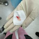 [연대세브란스치과] 9살 과잉치 발치 후기(통증,식사,주의사항,비용,실비)/ 9개월 경과 후 사진.