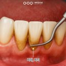 어등대로L | 광산구치과 잇몸 염증 꼭 확인해 주세요