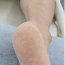 33 | 군산 나운동 발각질 까칠까칠한 발 매끈매끈하게 변신 비엔네일