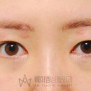 에이엠성형외과의원 네이버블로그