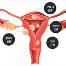 자궁내막증 자궁근종 원인 증상 치료 불임의 원인 자궁내막증 이미지