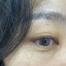 울산제일안과의원 | 울산 삼산동 밝은안과 스마트라섹 7일차! 지옥의 3일차 견디고 보호렌즈 뺀 생생 후기