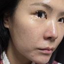 이건한의원 | 노원역 한의원 코 모공 축소 시술효과 리뷰(3회차)