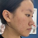도들두들 | 디페린겔 2주차 | 디페린겔 후기 | 디페린겔 부작용