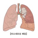 비소세포성 폐암[Non-small cell lung cancer]종양혈액질환, 호흡기질환 이미지