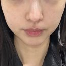 그린외과의원 | 티타늄 리프팅 후기 _ 픽셀랩 성형외과(찐후기) 내돈내산