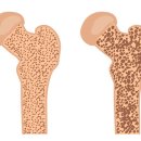 뼈에 영향을 주는 질병(疾病) 이미지