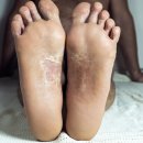 "무좀인 줄 알았는데" 췌장암 걸리면 발가락에 생긴다는 '이 증상' 이미지