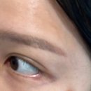 서울에이치피부과의원 | [서울에이치피부과] 눈가 푸른 정맥혈관 치료 “클라리티레이저” 1회차