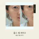 돈랩 | 투턱 고민으로 시작한 홈 케어 홀드랩 써마3 내 돈 내산 후기
