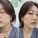 감일백제로83번길 | 하남피부관리 뷰티몽드 미사에스테틱 내돈내산 기미관리 전후
