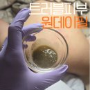 양덕동498 | 여드름흉터 개선에 강한 약초필, 원데이필 1회후기&amp;주의사항 총정리